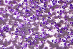 Diffuse_large_B_cell_lymphoma_-_cytology_low_mag